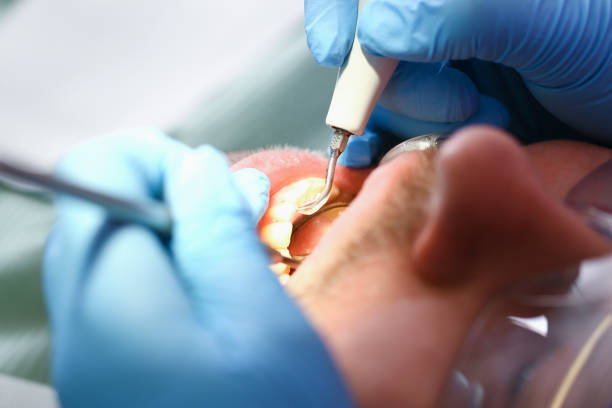 Best Dentist for Tooth Abscess  in Glenmont, MD